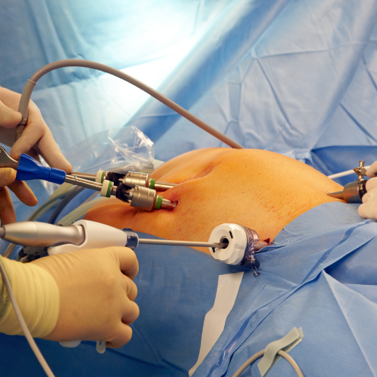 Laparoscopic surgery at Spire Hospital