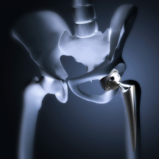 Understanding Hip and Knee Joint Replacement