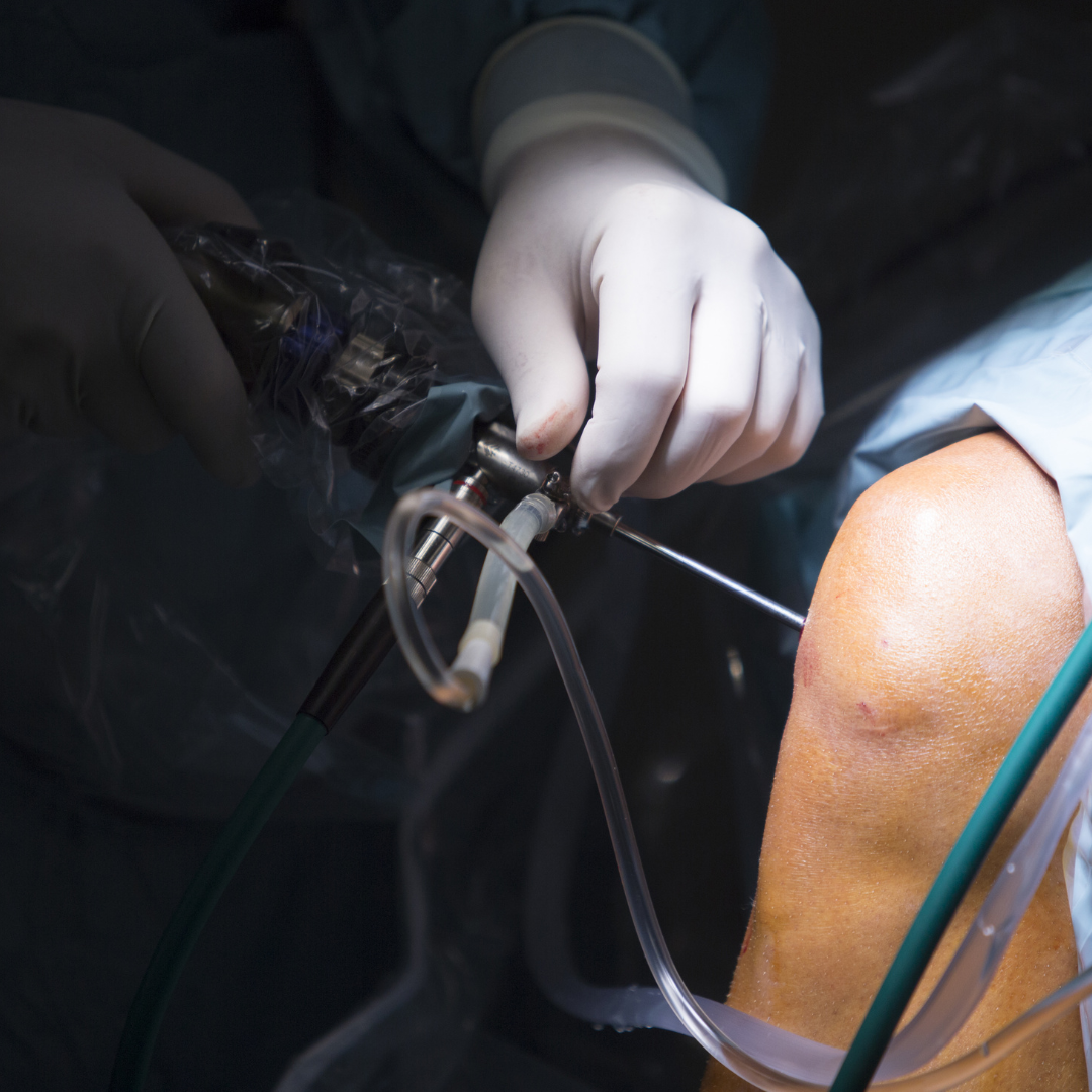 Arthroscopy at Spire Hospital