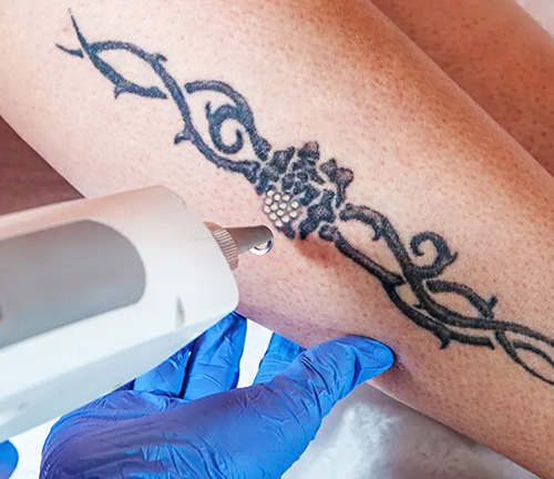 Tattoo Removal at Spire Hospital