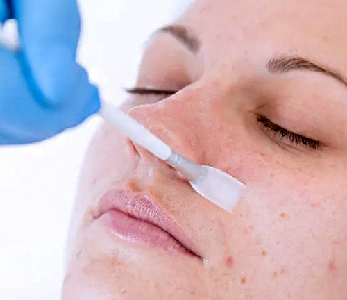 chemical peel at Spire Hospital