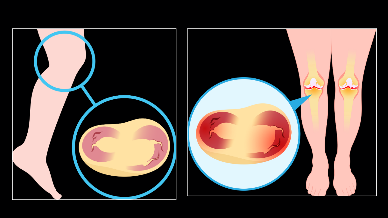 Meniscus Repair / Partial Meniscectomy