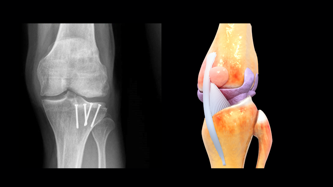 knee Joint Preservation Surgeries