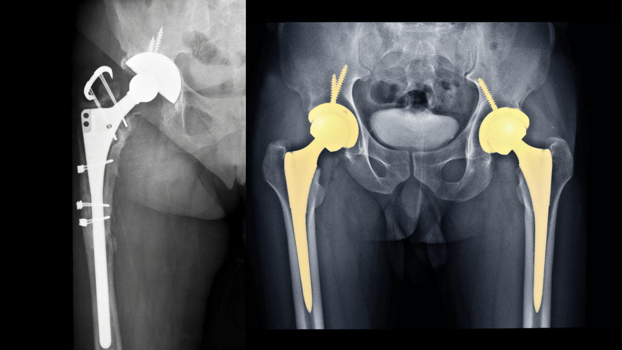 Complex Hip Replacement at Spire Hospital