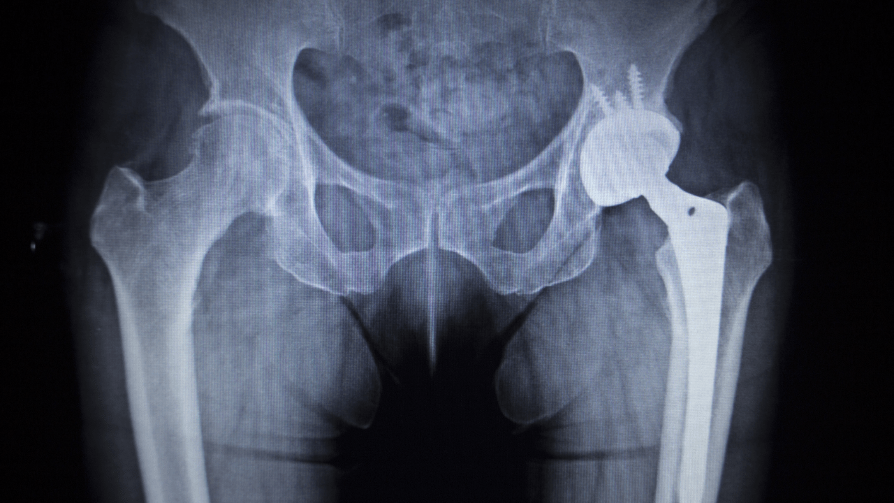 Partial Hip Replacement at Spire Hospital