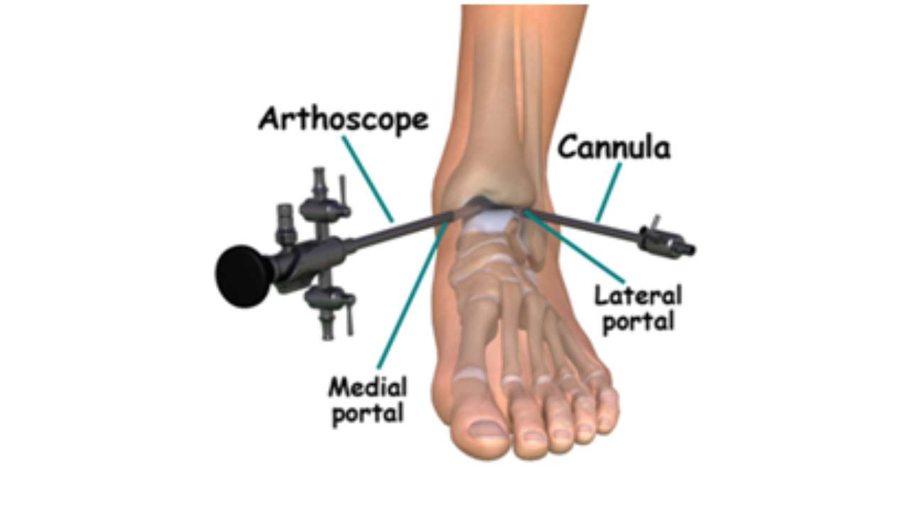 Arthroscopy at Spire Hospital