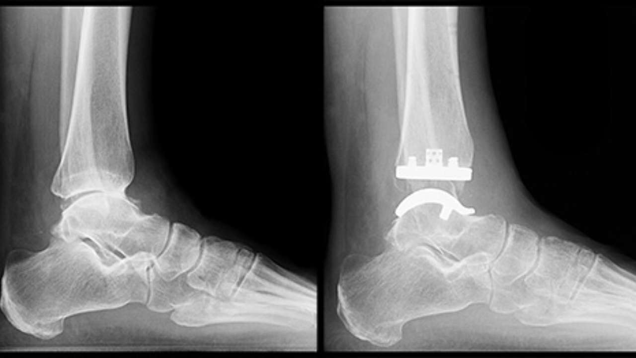 Joint Replacement at Spire Hospital<br />