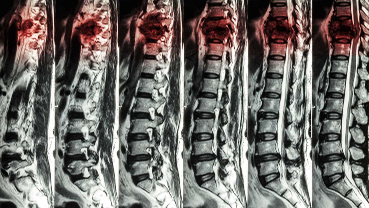 Treatment for Spinal Fractures