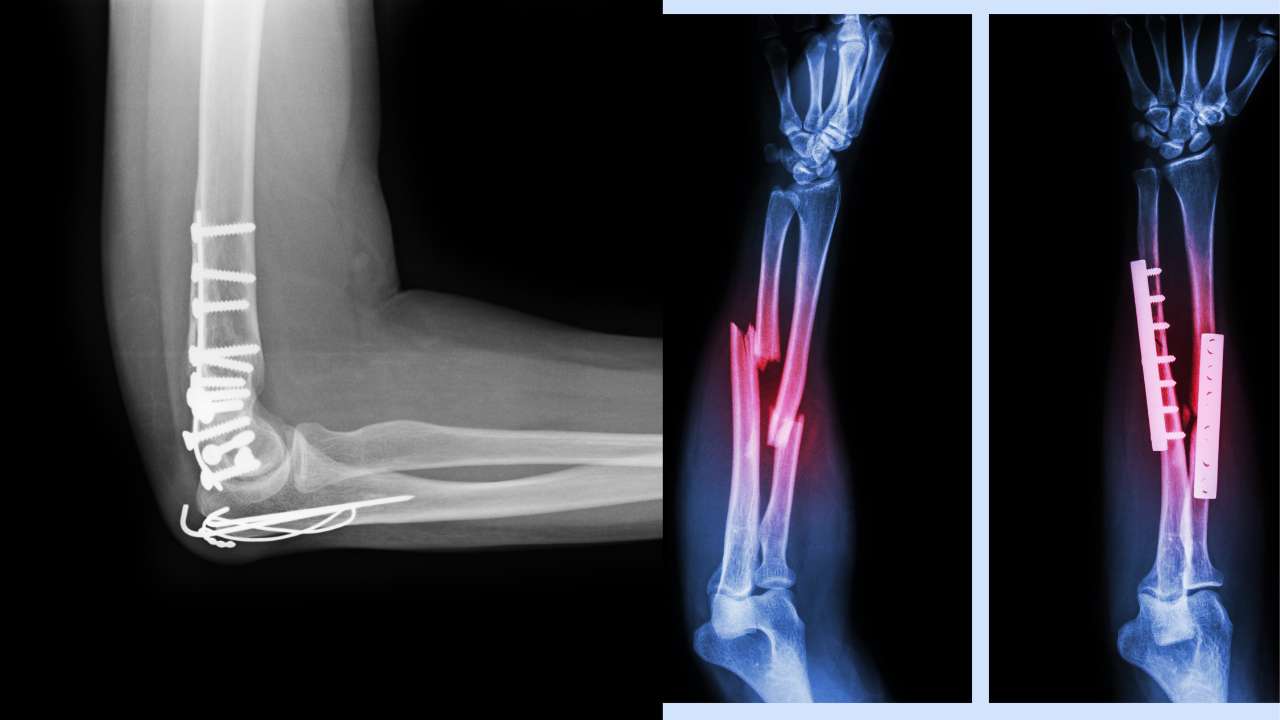 Elbow & Radius, Ulna Fracture Care