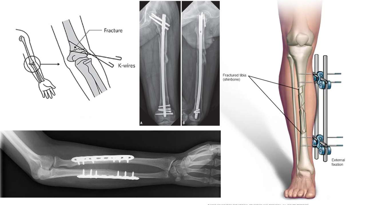 General Trauma & Fracture Management